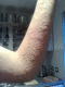 080707.Rash_t.gif